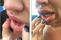 Hãi hùng cô gái môi thủng lỗ chỗ vì nghiện tiêm botox