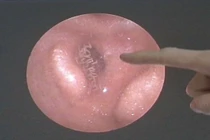 Nổi gai ốc clip hàng trăm con giòi ký sinh trong tai