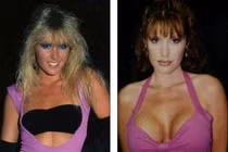 Nữ diễn viên Hollywood bị virus ăn mất ngực