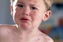 5 bệnh trẻ dễ mắc khi trời nồm ẩm