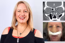 Diễn viên xinh đẹp bị bọ ăn thịt người ăn mất mũi