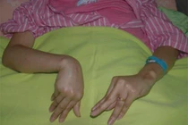 Thiếu nữ sùi bọt mép, giãy dụa, ngất xỉu vì thiếu canxi