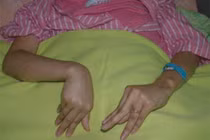 Thiếu nữ sùi bọt mép, giãy dụa, ngất xỉu vì thiếu canxi