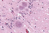 Báo động tử vong vì ăn phải thịt bò điên