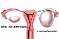 Sự thật mọi phụ nữ cần biết về u nang buồng trứng