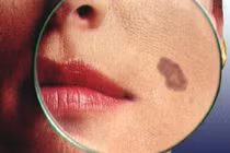 Giật mình xem rượu hủy hoại làn da một cách khủng khiếp