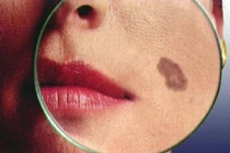 Giật mình xem rượu hủy hoại làn da một cách khủng khiếp