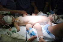  Tách thành công cặp song sinh dính liền bộ phận sinh dục, bụng 