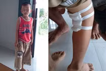 Kỷ luật hai bác sĩ mổ nhầm chân bé 6 tuổi