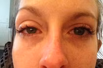 Suýt mù mắt vì kính áp tròng mài mòn giác mạc 