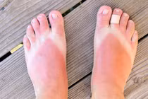 Hậu quả đáng sợ khi lười dùng kem chống nắng