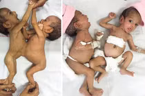 Tách thành công cặp song sinh dính liền bụng và ngực