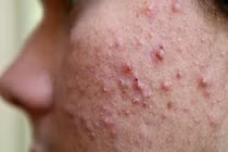 Tẩy tế bào chết cho da mụn - những điều cần tránh