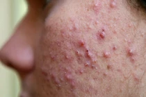 Tẩy tế bào chết cho da mụn - những điều cần tránh