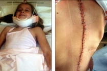 Hành trình 10 năm nắn cột sống cong vẹo của thiếu nữ đẹp