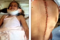 Hành trình 10 năm nắn cột sống cong vẹo của thiếu nữ đẹp