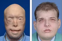 Hành trình ghép mặt của lính cứu hỏa bị bỏng nặng