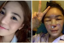 Gái trẻ công khai hình ảnh khủng khiếp do "dao kéo" hỏng