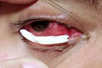 Người phụ nữ đau đớn vì khóc ra "nước mắt pha lê"