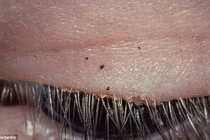 Cả đàn rận 20 con bò lổm ngổm trên mi mắt quý bà