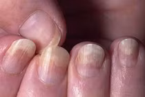Dấu hiệu ở móng tay cảnh báo bệnh ung thư, HIV