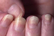 Dấu hiệu ở móng tay cảnh báo bệnh ung thư, HIV