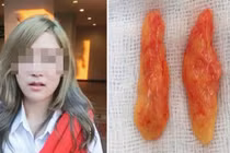 Hãi hùng cô gái cắt thịt ở má để có khuôn mặt v-line