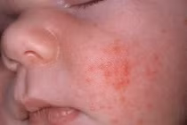 Triệu trứng trẻ sơ sinh bị dị ứng sữa