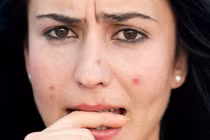 Nếu có dấu hiệu này, bạn hãy đi khám ung thư da