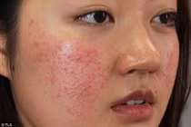 Da dễ dị ứng, có cách nào làm đẹp?