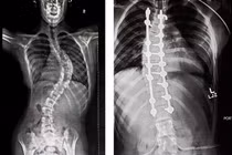 Hành trình uốn xương cực nhọc của cô bé vẹo cột sống