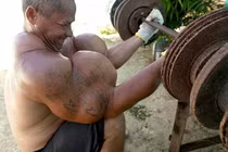 Clip bắp tay đầy mủ do tiêm dầu ăn tăng cường cơ bắp