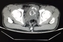 Thủ dâm quá lố, mắc kẹt dây điện trong bàng quang