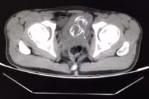 Thủ dâm quá lố, mắc kẹt dây điện trong bàng quang