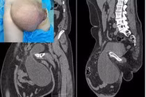 Quý ông có tinh hoàn to như quả bóng suốt 12 năm