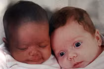 Kỳ lạ những ca sinh đôi nhưng mỗi con một bố 
