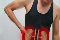 6 chiêu làm tan sỏi thận rất nhanh, không cần mổ