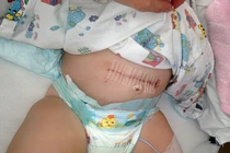 Hy hữu bé 10 ngày tuổi bị ung thư buồng trứng