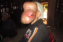 Mổ xẻ bệnh lạ khiến cụ bà mang khối u 3kg trên mặt