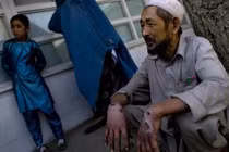 Virus ăn thịt người do IS gieo rắc có thể trở thành đại dịch mới