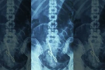 Bác sĩ bỏ quên kéo trong bụng bệnh nhân