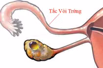 Nhiễm Chlamydia - nguy cơ “chết người” thầm lặng 