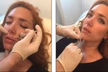 Cận cảnh tiêm nước muối vào môi để căng mọng trong 6 giờ