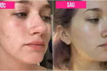 Tận mắt xem kết quả sốc sau 7 ngày không nặn mụn