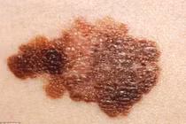 Uống nước cam buổi sáng làm tăng nguy cơ ung thư da?