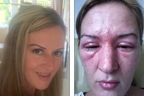 Hàng loạt phụ nữ hỏng giác mạc, mù mắt vì nối mi