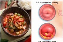 5 thực phẩm "nuôi" khối u xơ tử cung lớn mỗi ngày, cần tránh xa