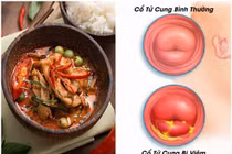 5 thực phẩm "nuôi" khối u xơ tử cung lớn mỗi ngày, cần tránh xa