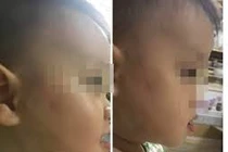 Hà Nội: Làm rõ bé gần 2 tuổi bị đánh bầm tím ở trường