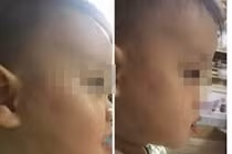 Hà Nội: Làm rõ bé gần 2 tuổi bị đánh bầm tím ở trường